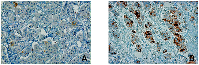 PSCA-expression levels in breast cancer tissue.