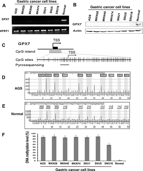 GPX7 is silenced and hypermethylated in gastric cancer cell lines.