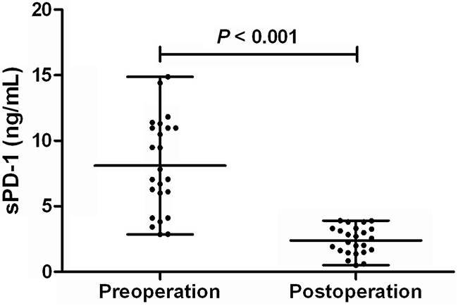 sPD-1 levels before and after tumor resection in patients with hepatitis B virus-associated hepatocellular carcinoma.