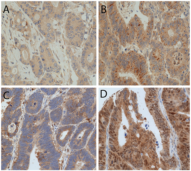 LC3B and p62 immunohistochemical staining in CC tissue.