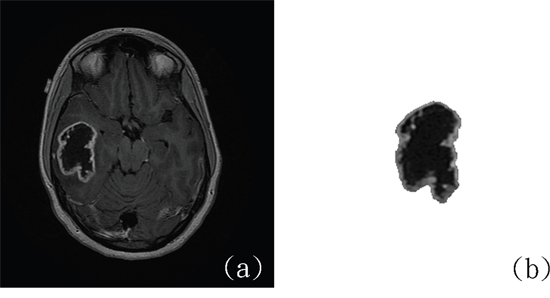 The only IDH-mutant case of GBM misclassified using the CAD system.