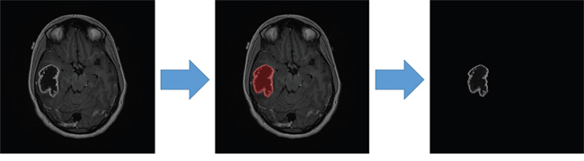 Tumor contour delineation in contrast-enhanced axial T1WIs.