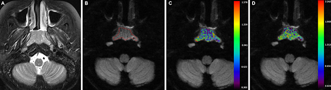 A-43-years-old man with nasopharyngeal carcinoma staged at T1N2M0.