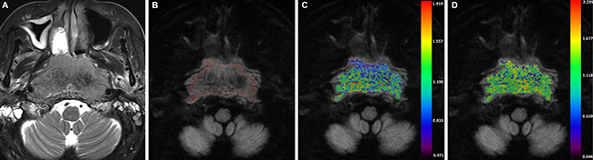 A-54-years-old man with nasopharyngeal carcinoma staged at T4N0M0.