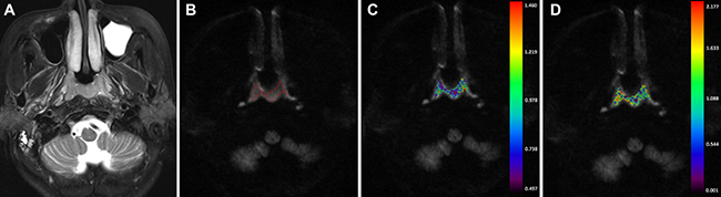 A-56-year-old man nasopharyngeal carcinoma staged at T1N2M0.
