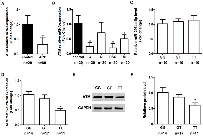 The correlation of SNP rs4585 with ATM expression in anterior capsules.