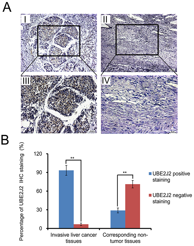 IHC analysis of UBE2J2 in invasive HC and corresponding non-tumor tissues.