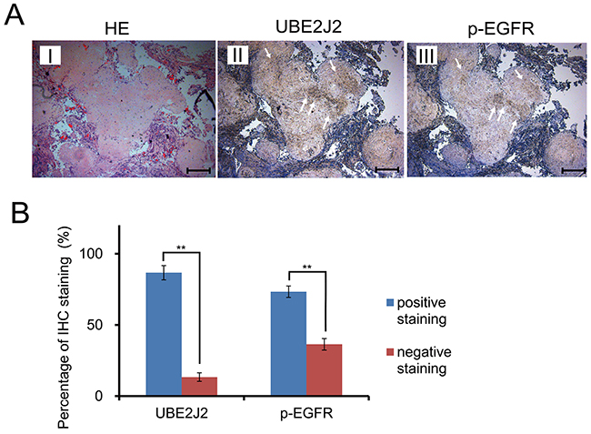 UBE2J2 and p-EGFR expression in invasive HC serial sections.