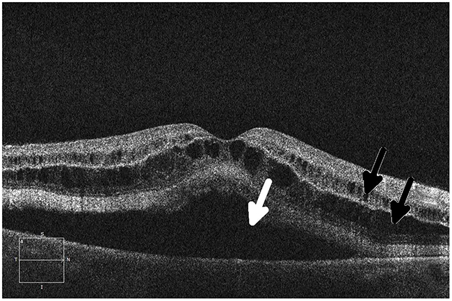 Ocular coherence tomography (OCT) shows intraretinal (black arrows) and subretinal (white arrow) fluid in a patient being treated with a MEK inhibitor who subsequently developed grade 2 retinopathy with retinal and subretinal cysts.