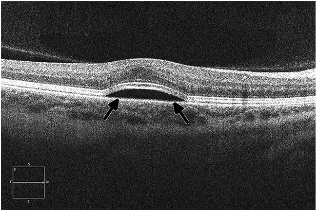 Ocular coherence tomography (OCT) displays a perpendicular cut through the retina in a patient with metastatic melanoma undergoing therapy with a small-molecule ERK inhibitor, demonstrating central serous retinopathy with subretinal fluid buildup (arrows).