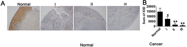 STC1 expression was associated with tumor stage in cervical cancer.