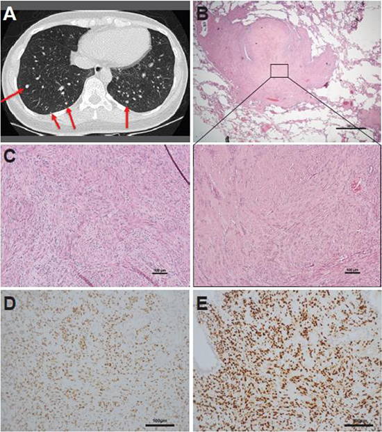 Representative case of a synchronous lung and uterine leiomyomata (case 1).
