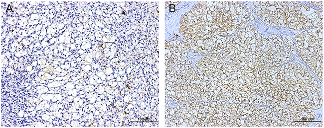 Representative photograph of FUT3 immunostaining in TMA (magnification * 200, scale bar &#x003D; 100 &#x03BC;m).