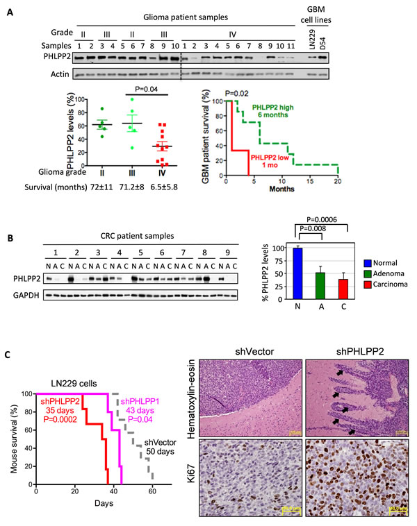 PHLPP2: progression marker in glioma and CRC.