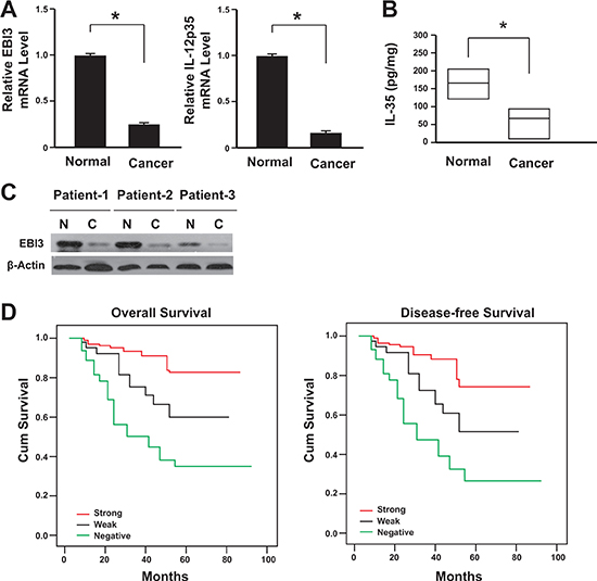 Lack of IL-35 expression correlated with the poor prognosis of colon cancer.