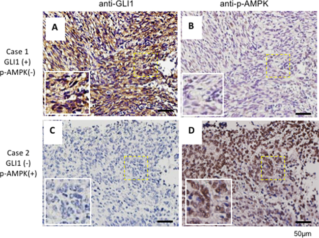 GLI1 expression inversely correlates with p-AMPK in human brain cancer tissues.