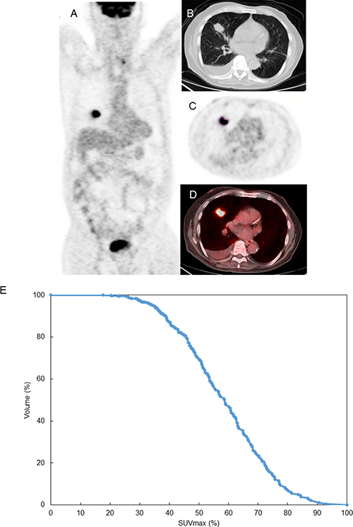 Images and measurement result of FDG PET parameter of lung tumor at right middle lobe.