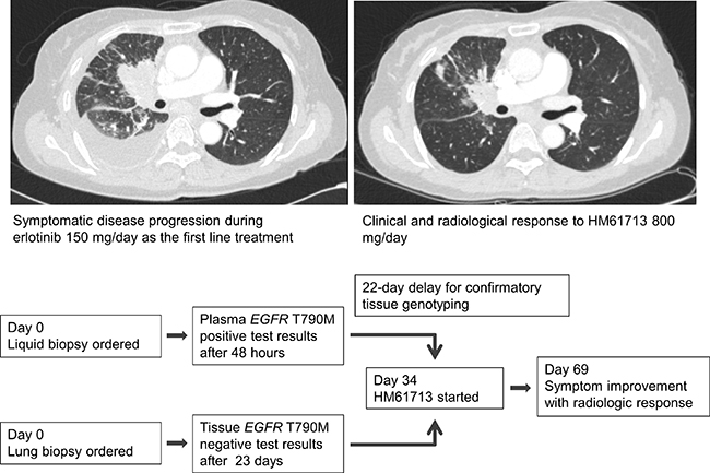 A patient with metastatic NSCLC with acquired resistance to erlotinib who showed a partial response to third-generation TKI.