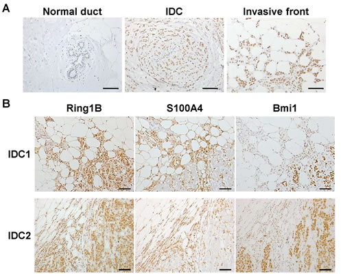 Ring1B expression in invasive ductal breast carcinoma.