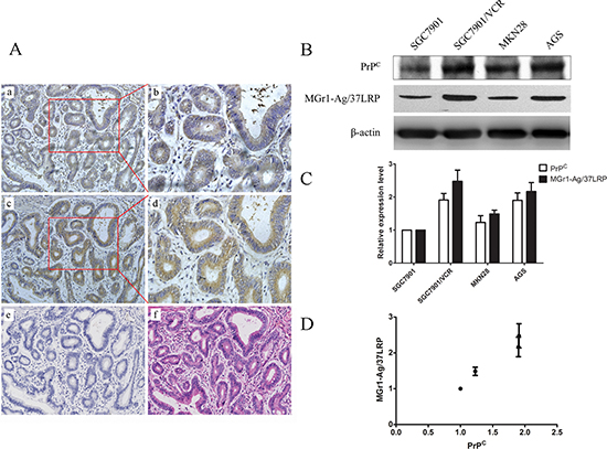 Expression pattern of PrPC and MGr1-Ag/37LRP protein in gastric cancer tissue and cell lines.