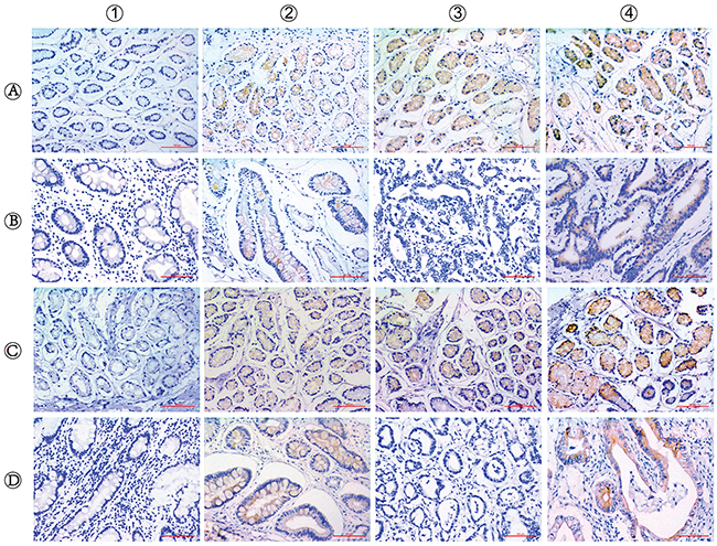 Immunohistochemical staining for ERCC6 and ERCC8 expression in CSG, CAG and GC.