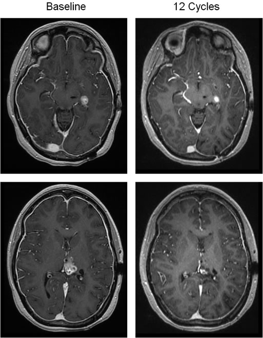 Objective response in a patient with recurrent glioblastoma.