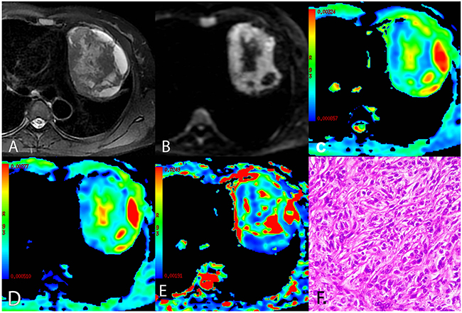 A representative case of low risk thymoma (type A).