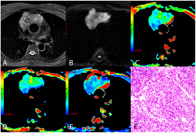 A representative case of high risk thymoma (type B3).