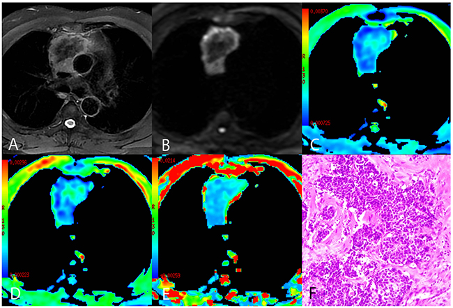 A representative case of thymic squamous cell carcinoma.