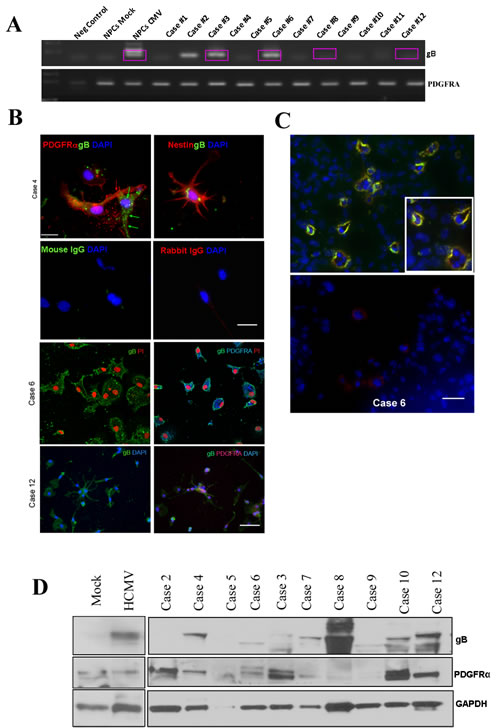 HCMV glycoprotein B mRNA and protein are endogenously expressed in human glioblastoma tissues and co-localize with PDGFR&#x3b1; in situ.