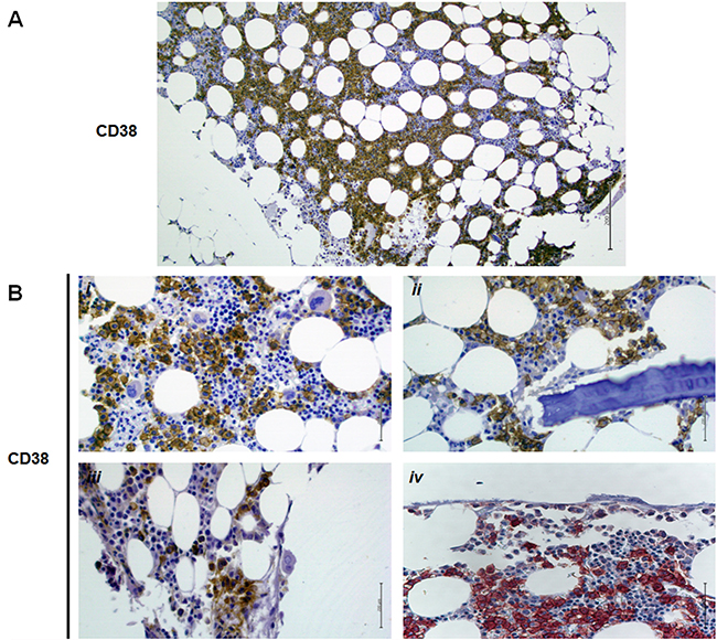 CD38 expression on bone biopsies of MM patients.
