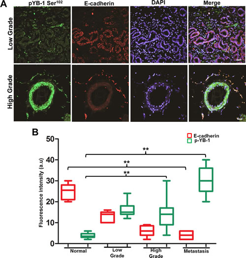 YB-1 expression increases with increase in tumor grade and is negatively correlated with E-cadherin expression in human PCa tissues.