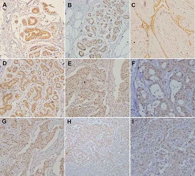 ING5 expression in breast carcinogenesis and subsequent progression.