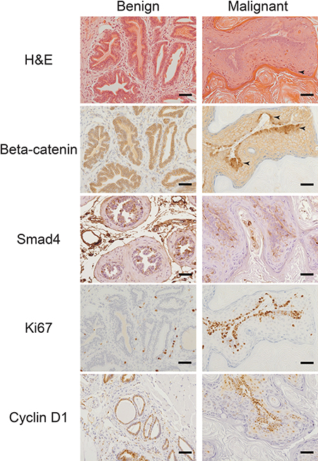 Gain of beta-catenin expression plus loss of Smad4 expression is associated with increased proliferation.
