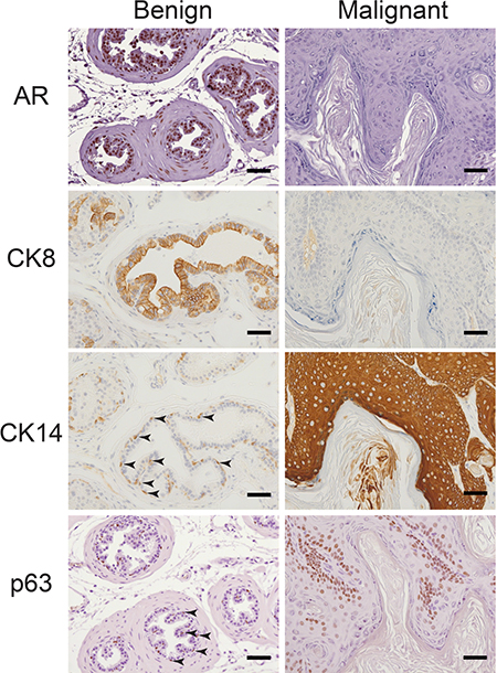 Concurrent loss of AR and luminal marker CK8 and expansion of basal markers CK14 and p63 in malignant tissue.