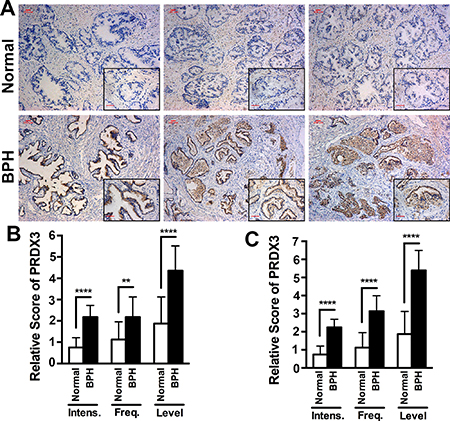 The expression of PRDX3 protein in human prostatic tissues.