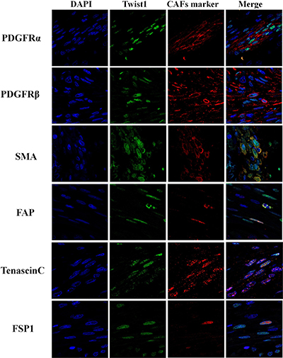 Immunofluorescence analysis of Twist1 and cancer associated fibroblast markers (PDGFR&#x03B1;, PDGFR&#x03B2;, SMA, FAP, Tenascin C and FSP1) in stromal fibroblast of esophageal squamous cell carcinoma.