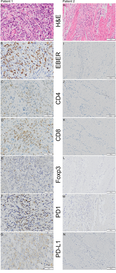 Representative examples of H&#x0026;E staining, EBER (Epstein-Barr Virus-encoded RNA) in situ hybridization and CD4 (cluster of differentiation 4), CD8 (cluster of differentiation 8), Foxp3 (Forkhead box P3), PD-1 (programmed death 1), and PD-L1 (programmed death ligand-1) immunohistochemistry staining in 2 patients.