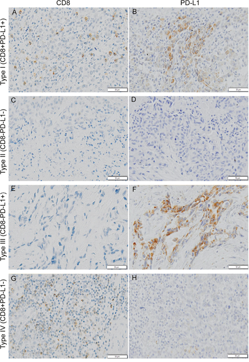 Typical examples of four types of tumor immune microenvironment based on CD8 (cluster of differentiation 8) and PD-L1 (programmed death ligand 1) immunohistochemistry staining.