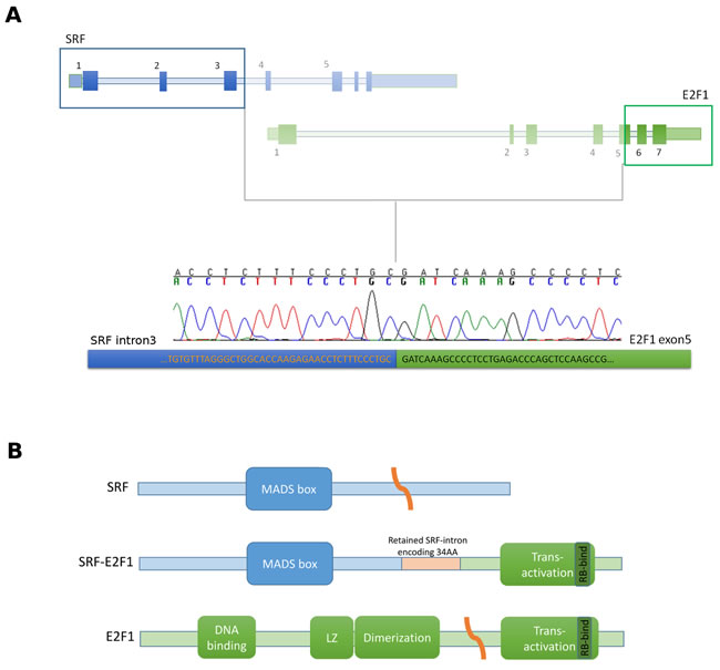 SRF-E2F1 fusion transcript identified by whole-transcriptome sequencing.