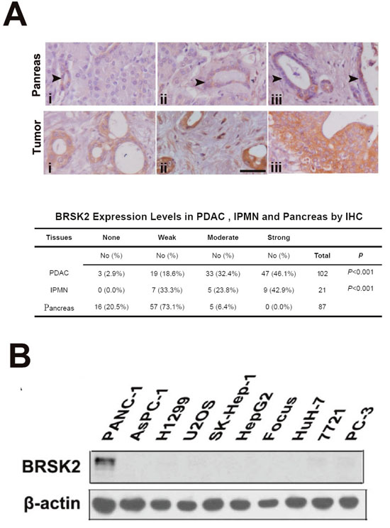 BRSK2 was upregulated in PDAC and IPMN tumors.