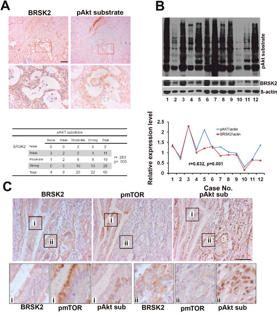 The relationship of BRSK2, pAkt substrate and pmTORS (2448) in cancer cells of human PDAC tissues.