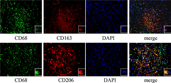 Immunofluorescence staining of HCC tissues.