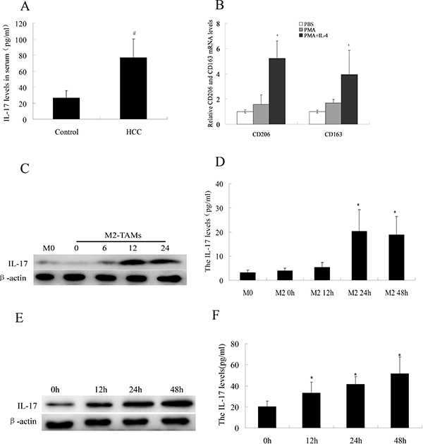 IL-17 levels in serum and HCC cells.