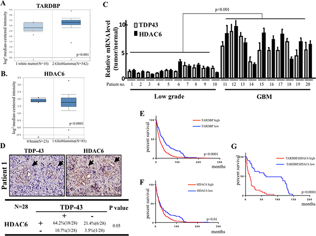 Clinical significance of TDP-43/HDAC6 protein expression and survival of human brain tumors patients.