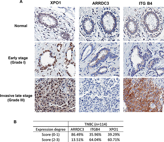 ARRDC3 expression is low in many TNBC tumors and inversely correlates with the levels of XPO1 and integrin &#x03B2;4.