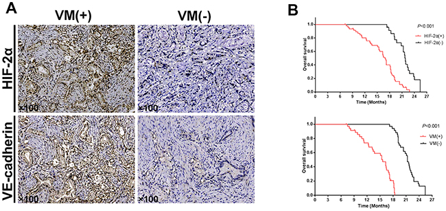 Correlation of HIF-2&#x03B1;, VE-cadherin, and VM in tissues, and the HIF-2&#x03B1; and VM expression survival curves in pancreatic cancer patients.