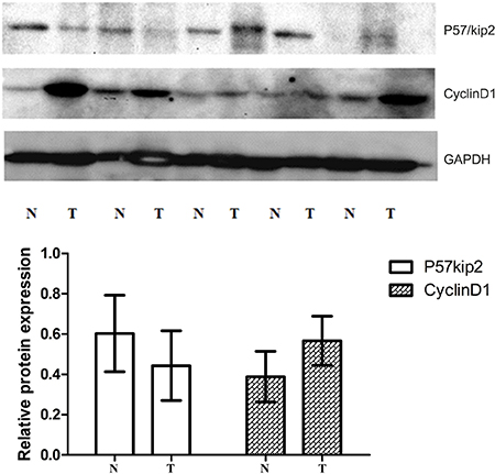 Western-blot (WB) of tissue cycclinD1 protein and P57/Kip2 protein in GCA and the adjacent non-cancerous tissues.