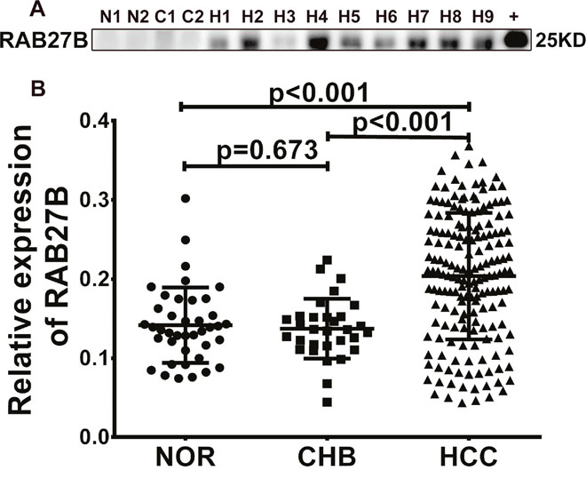 RAB27B is highly expressed in the serum of patients with hepatocellular carcinoma (HCC).