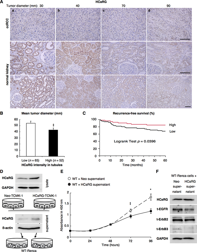 HCaRG is less expressed in human ccRCCs than in normal renal tubules.